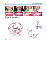 Orthodontic Management of Class II Malocclusion: An Evidence-Based Guide 2024 - Image 12