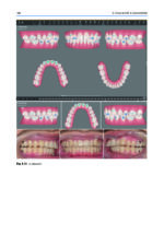 Orthodontic Management of Class II Malocclusion: An Evidence-Based Guide 2024 - Image 14