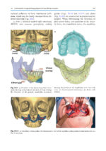 Orthodontic Management of Class II Malocclusion: An Evidence-Based Guide 2024 - Image 15