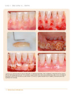 Clinical Cases in Periodontics 2022 (2nd Edition) - Image 8
