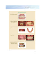 Everyone Can Achieve SUCTION-EFFECTIVE Mandibular Complete Denture 2020 - Image 8