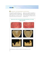 Everyone Can Achieve SUCTION-EFFECTIVE Mandibular Complete Denture 2020 - Image 6