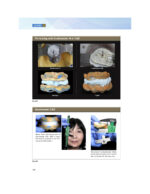 Everyone Can Achieve SUCTION-EFFECTIVE Mandibular Complete Denture 2020 - Image 5