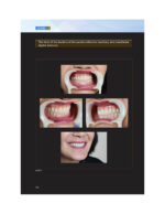 Everyone Can Achieve SUCTION-EFFECTIVE Mandibular Complete Denture 2020 - Image 2