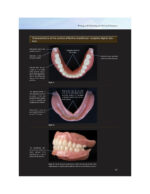 Everyone Can Achieve SUCTION-EFFECTIVE Mandibular Complete Denture 2020 - Image 3