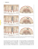 Techniques for Success with Implants in the Esthetic Zone 2019 - Image 15