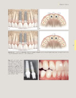 Techniques for Success with Implants in the Esthetic Zone 2019 - Image 9