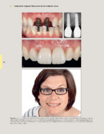 Techniques for Success with Implants in the Esthetic Zone 2019 - Image 3