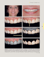 Techniques for Success with Implants in the Esthetic Zone 2019 - Image 4