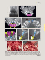 Techniques for Success with Implants in the Esthetic Zone 2019 - Image 7