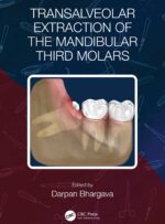 Transalveolar Extraction of the Mandibular Third Molars 2023