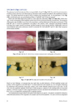 Introduction to Implant Prosthodontics: A case-based Clinical Guide 2022 - Image 9
