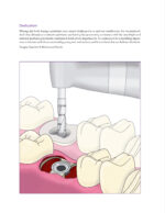 Immediate Molar Implants 2023 - Image 7