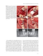 Immediate Molar Implants 2023 - Image 6