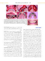 بازسازی استخوان در جهات عرضی و عمودی در راستای درمان ایمپلنت های دندانی - Image 9