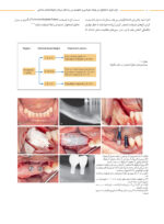 بازسازی استخوان در جهات عرضی و عمودی در راستای درمان ایمپلنت های دندانی - Image 3