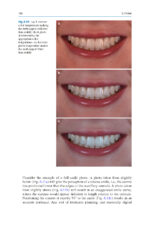 Esthetic Oral Rehabilitation with Veneers: A Guide to Treatment Preparation and Clinical Concepts 2020 - Image 14