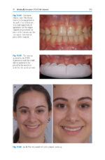 Esthetic Oral Rehabilitation with Veneers: A Guide to Treatment Preparation and Clinical Concepts 2020 - Image 5