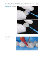 Esthetic Oral Rehabilitation with Veneers: A Guide to Treatment Preparation and Clinical Concepts 2020 - Image 7