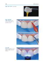 Esthetic Oral Rehabilitation with Veneers: A Guide to Treatment Preparation and Clinical Concepts 2020 - Image 8