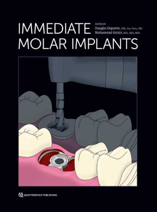 Immediate Molar Implants