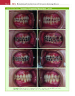 ORTHODONTICS: Current Principles and Techniques (Graber) 2023 + Supplemental Online Pages - Image 14