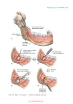 Principles of Dentoalveolar Extractions 2021 - Image 8