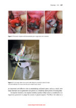 Bone-Grafting Biomaterials: Autografts, Hydroxyapatite, Calcium-Phosphates, and Biocomposites 2024 - Image 7