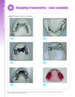 Removable Prosthodontics at a Glance 2020 - Image 8