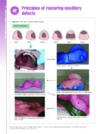 Removable Prosthodontics at a Glance 2020 - Image 9
