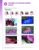 Removable Prosthodontics at a Glance 2020 - Image 9