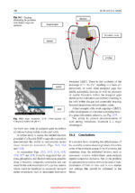Dentine Hypersensitivity: Advances in Diagnosis, Management, and Treatment 2024 (2nd Edition) - Image 7