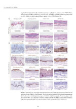 Oral Cancer Prophylaxis, Etiopathogenesis and Treatment 2025 - Image 9