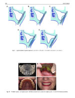 Perspectives on Zygomatic Implants 2021 - Image 6