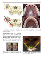 Perspectives on Zygomatic Implants 2021 - Image 4