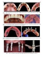 Perspectives on Zygomatic Implants 2021 - Image 2