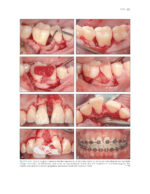 The Ortho-Perio Patient: Clinical Evidence and Therapeutic Guidelines 2019 - Image 7