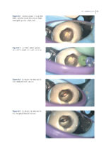 Clinical Atlas of Retreatment in Endodontics 2021 - Image 3