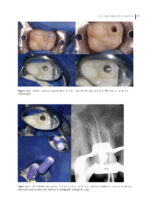 Clinical Atlas of Retreatment in Endodontics 2021 - Image 5