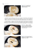 Clinical Atlas of Retreatment in Endodontics 2021 - Image 6