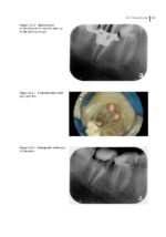Clinical Atlas of Retreatment in Endodontics 2021 - Image 7
