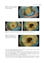Clinical Atlas of Retreatment in Endodontics 2021 - Image 9