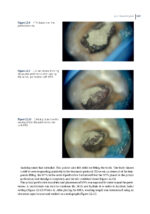 Clinical Atlas of Retreatment in Endodontics 2021 - Image 10