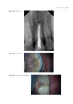 Clinical Atlas of Retreatment in Endodontics 2021 - Image 11