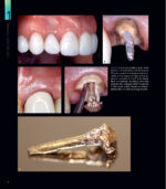 RESTORING THE INTRARADICULAR SPACE: ESTHETIC POST SYSTEMS 2021 - Image 2