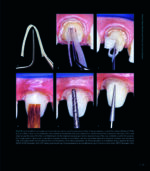 RESTORING THE INTRARADICULAR SPACE: ESTHETIC POST SYSTEMS 2021 - Image 3