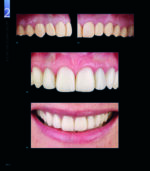 RESTORING THE INTRARADICULAR SPACE: ESTHETIC POST SYSTEMS 2021 - Image 4