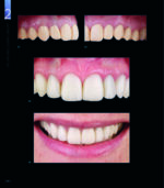 RESTORING THE INTRARADICULAR SPACE: ESTHETIC POST SYSTEMS 2021 - Image 4