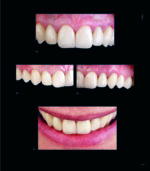 RESTORING THE INTRARADICULAR SPACE: ESTHETIC POST SYSTEMS 2021 - Image 5