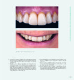 RESTORING THE INTRARADICULAR SPACE: ESTHETIC POST SYSTEMS 2021 - Image 8